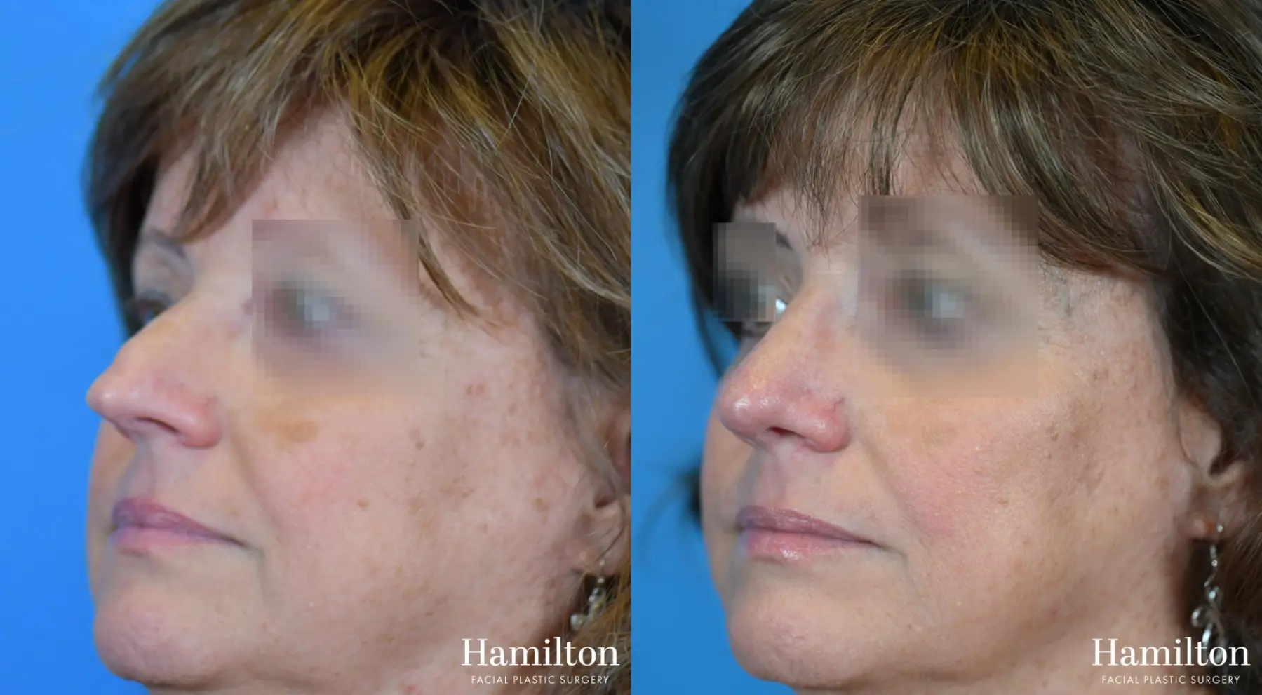 Rhinoplasty: Patient 21 - Before and After 4