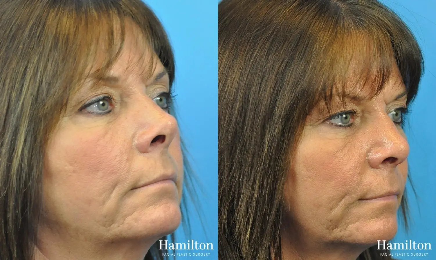 Rhinoplasty: Patient 48 - Before and After 1