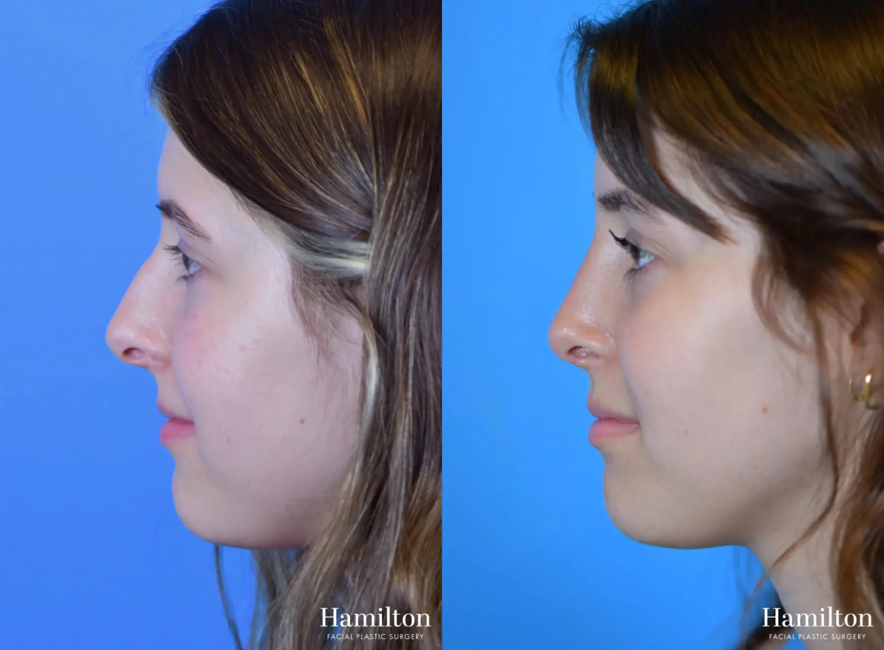 Rhinoplasty: Patient 22 - Before and After 5