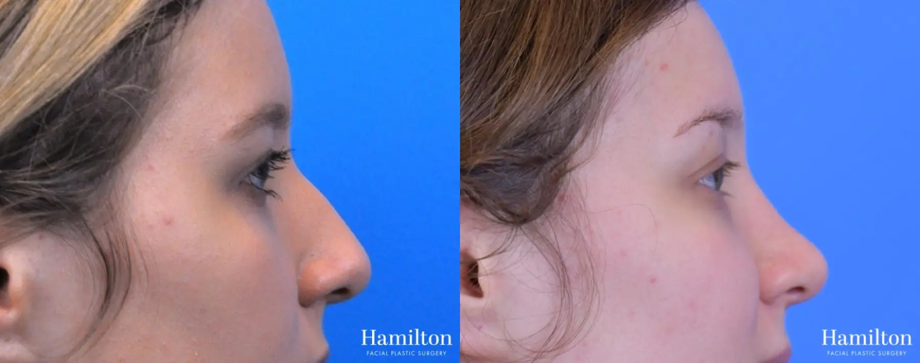 Rhinoplasty: Patient 20 - Before and After 1