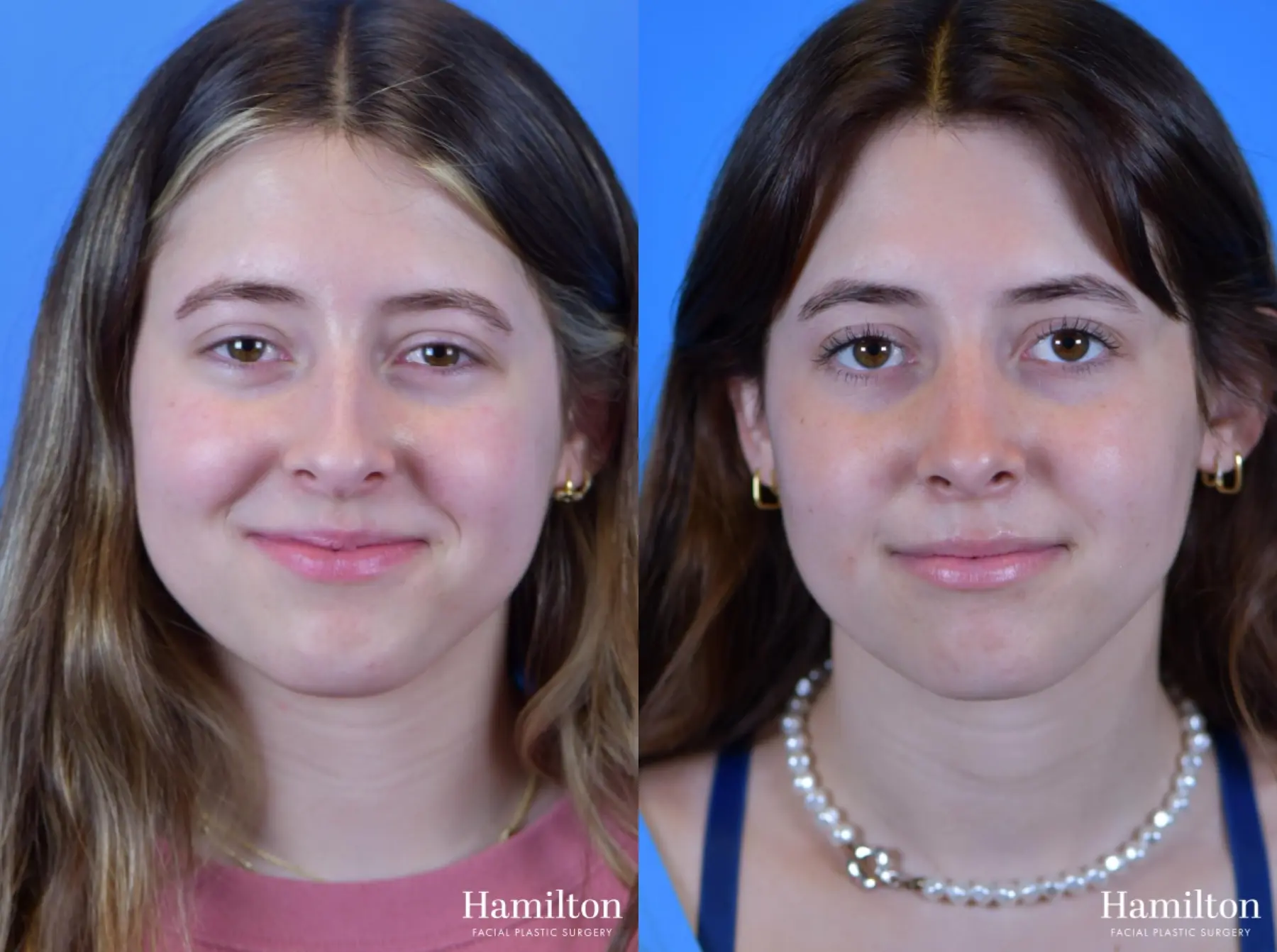 Rhinoplasty: Patient 22 - Before and After 1