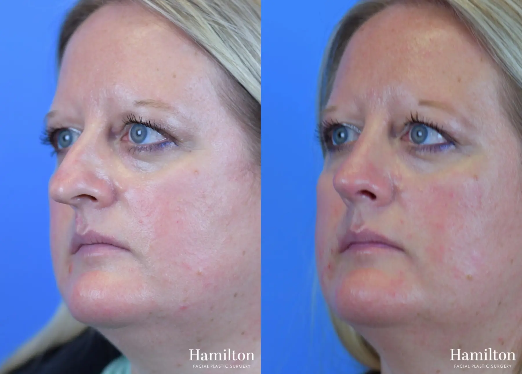 Rhinoplasty: Patient 18 - Before and After 4