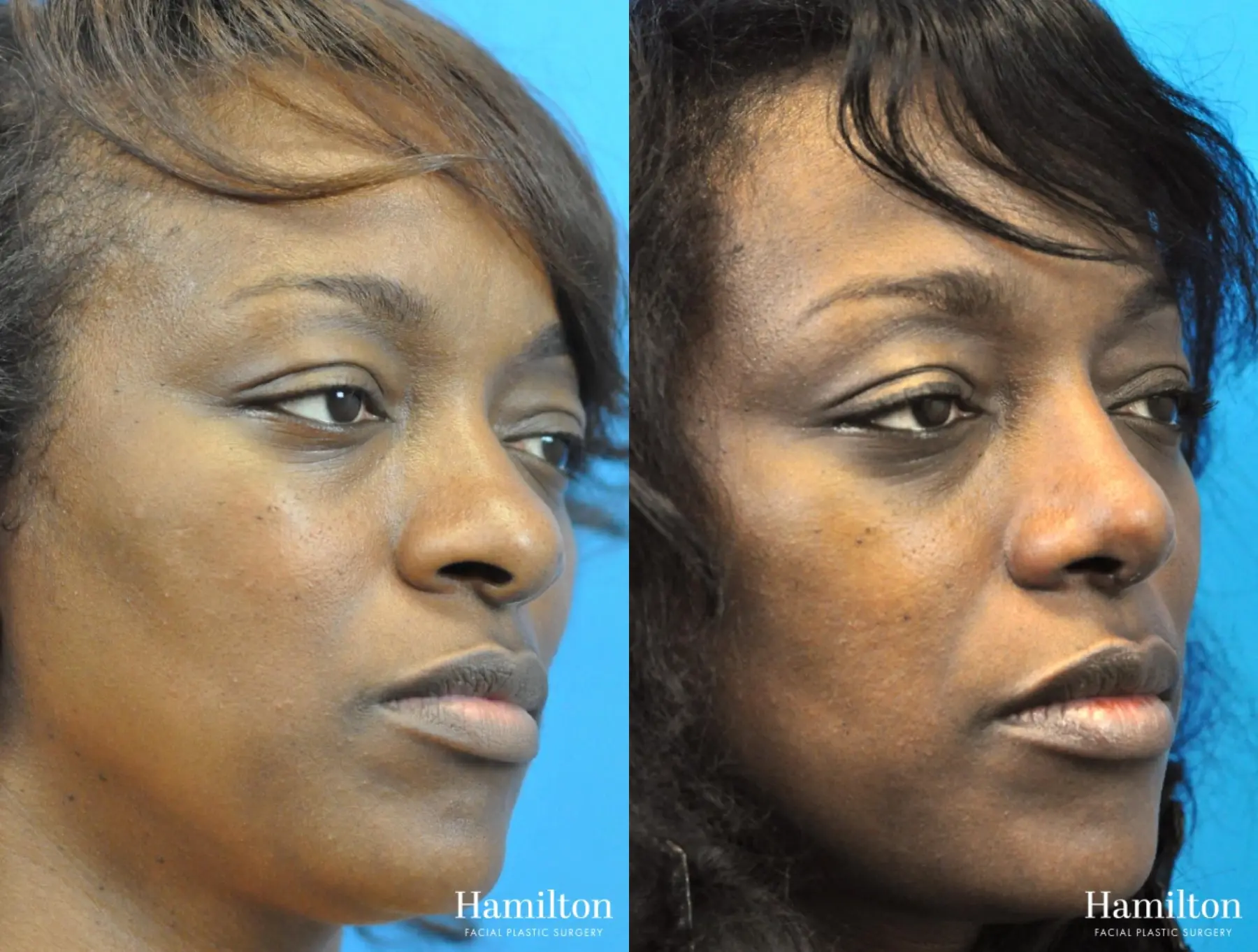 Rhinoplasty: Patient 28 - Before and After 4