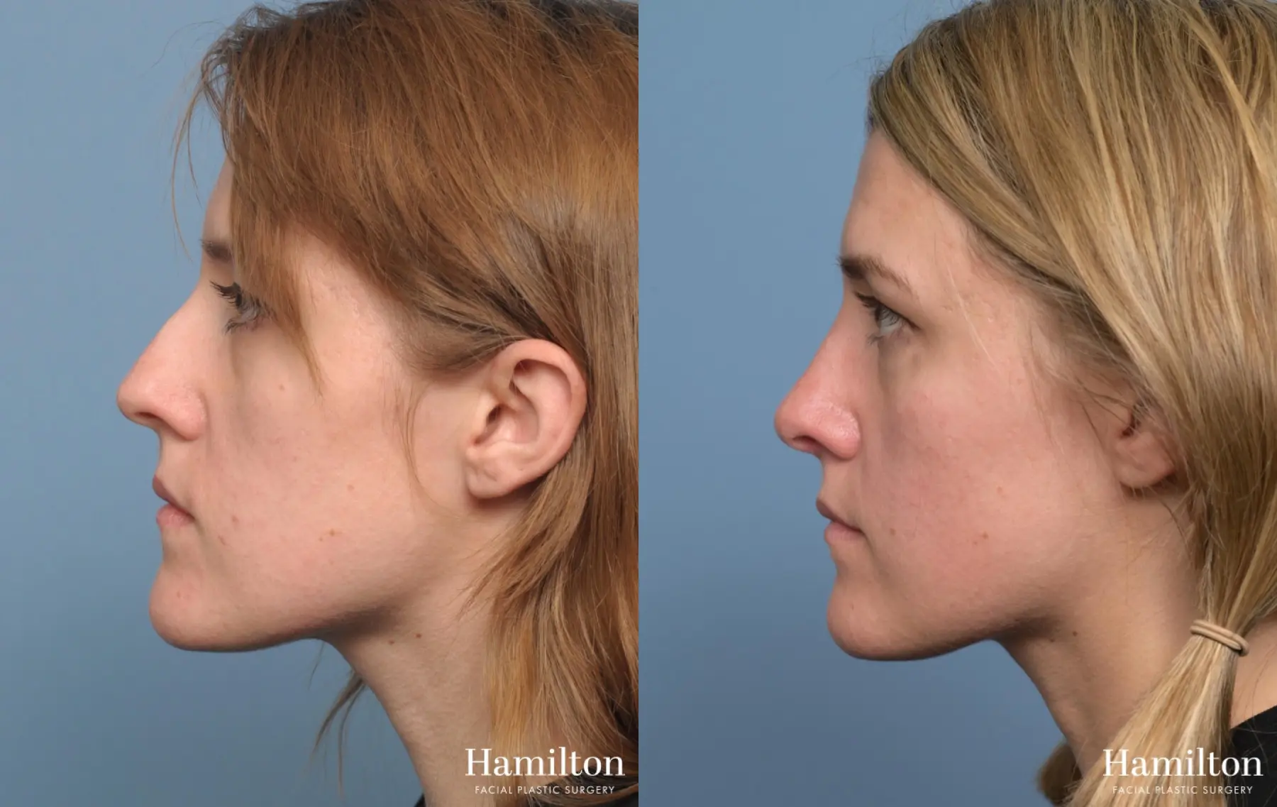Rhinoplasty: Patient 3 - Before and After 2