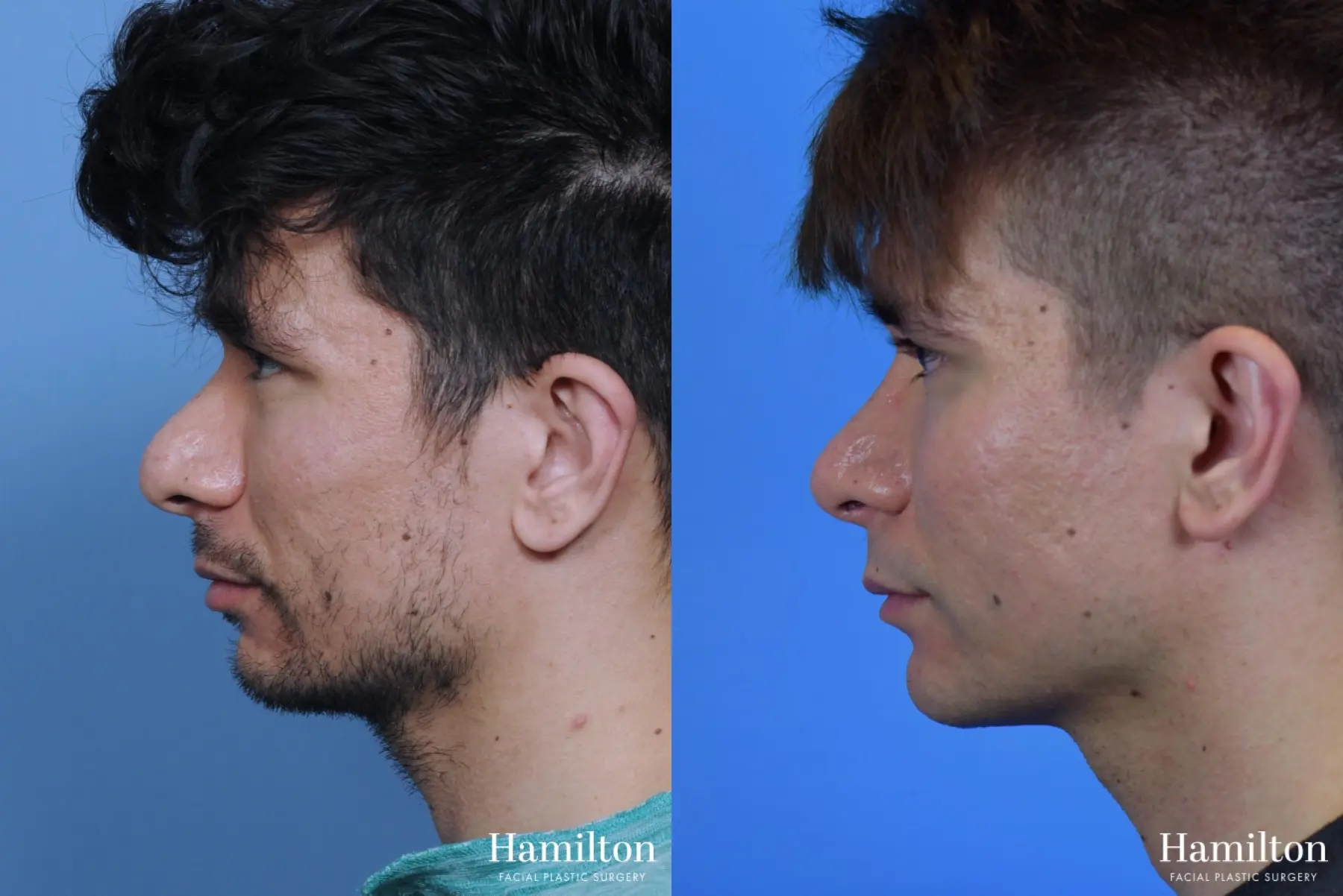Rhinoplasty: Patient 19 - Before and After 2