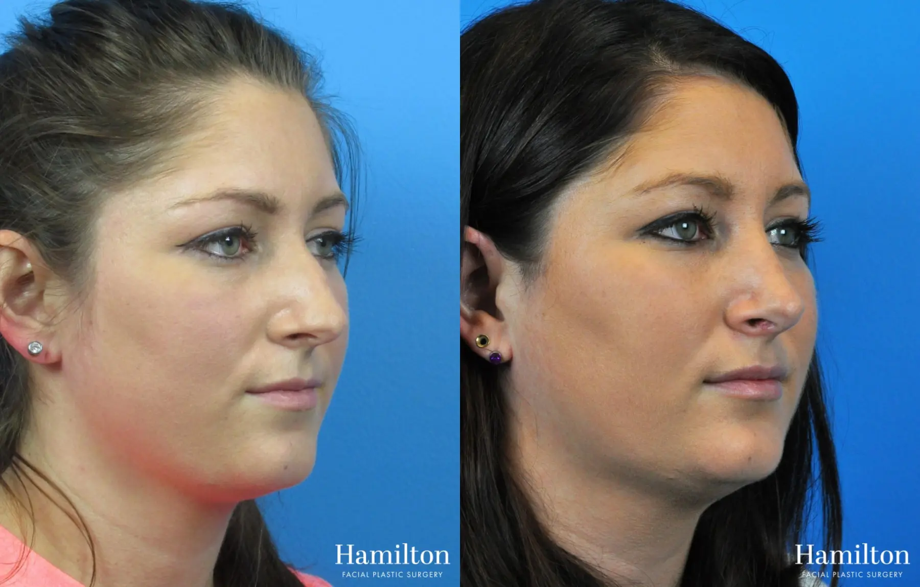 Rhinoplasty: Patient 53 - Before and After 3