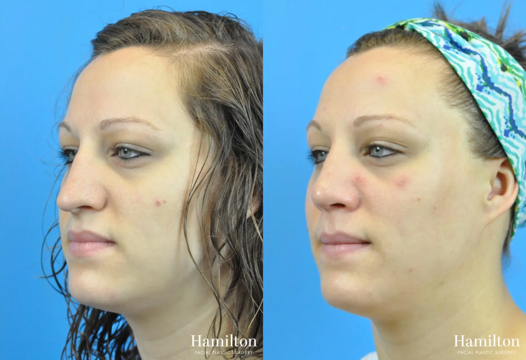 Rhinoplasty: Patient 51 - Before and After 3