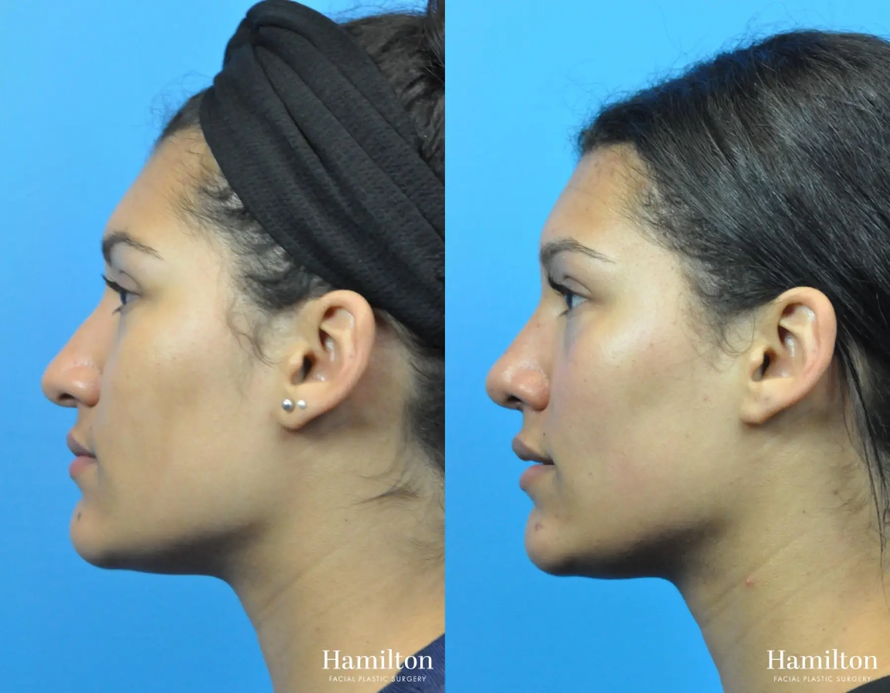 Rhinoplasty: Patient 45 - Before and After 2