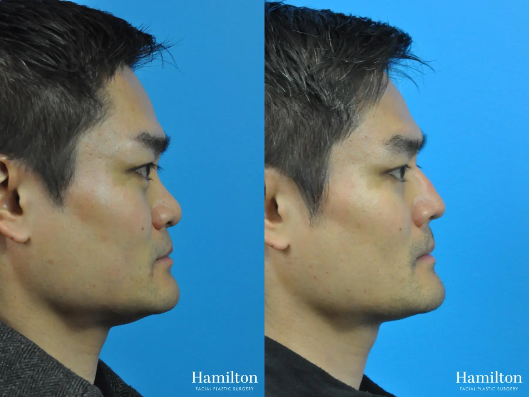 Rhinoplasty: Patient 26 - Before and After  