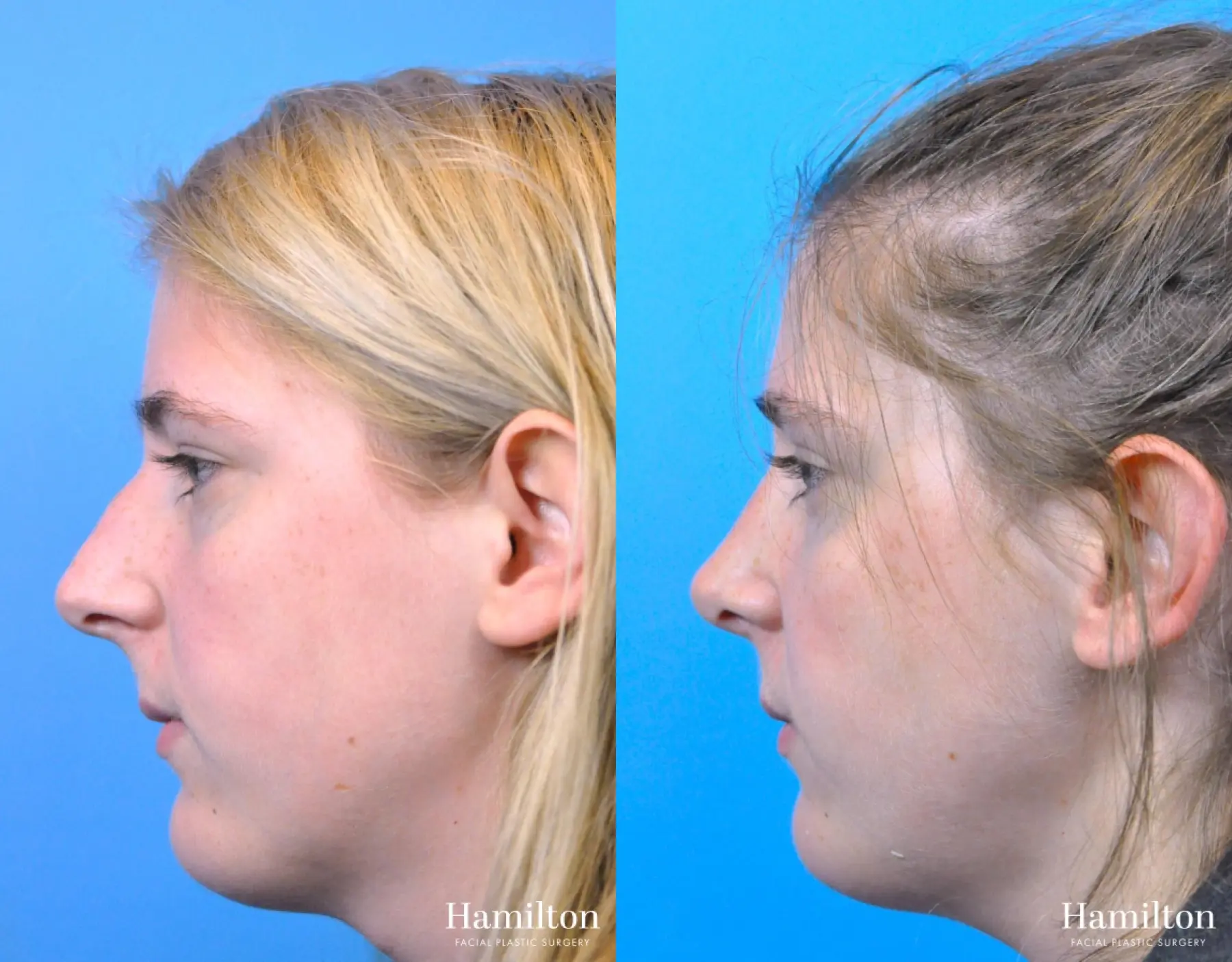 Rhinoplasty: Patient 50 - Before and After 4