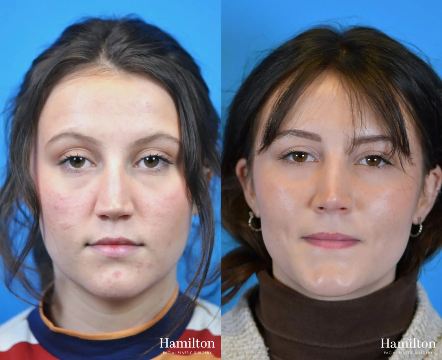 Rhinoplasty: Patient 17 - Before and After 5