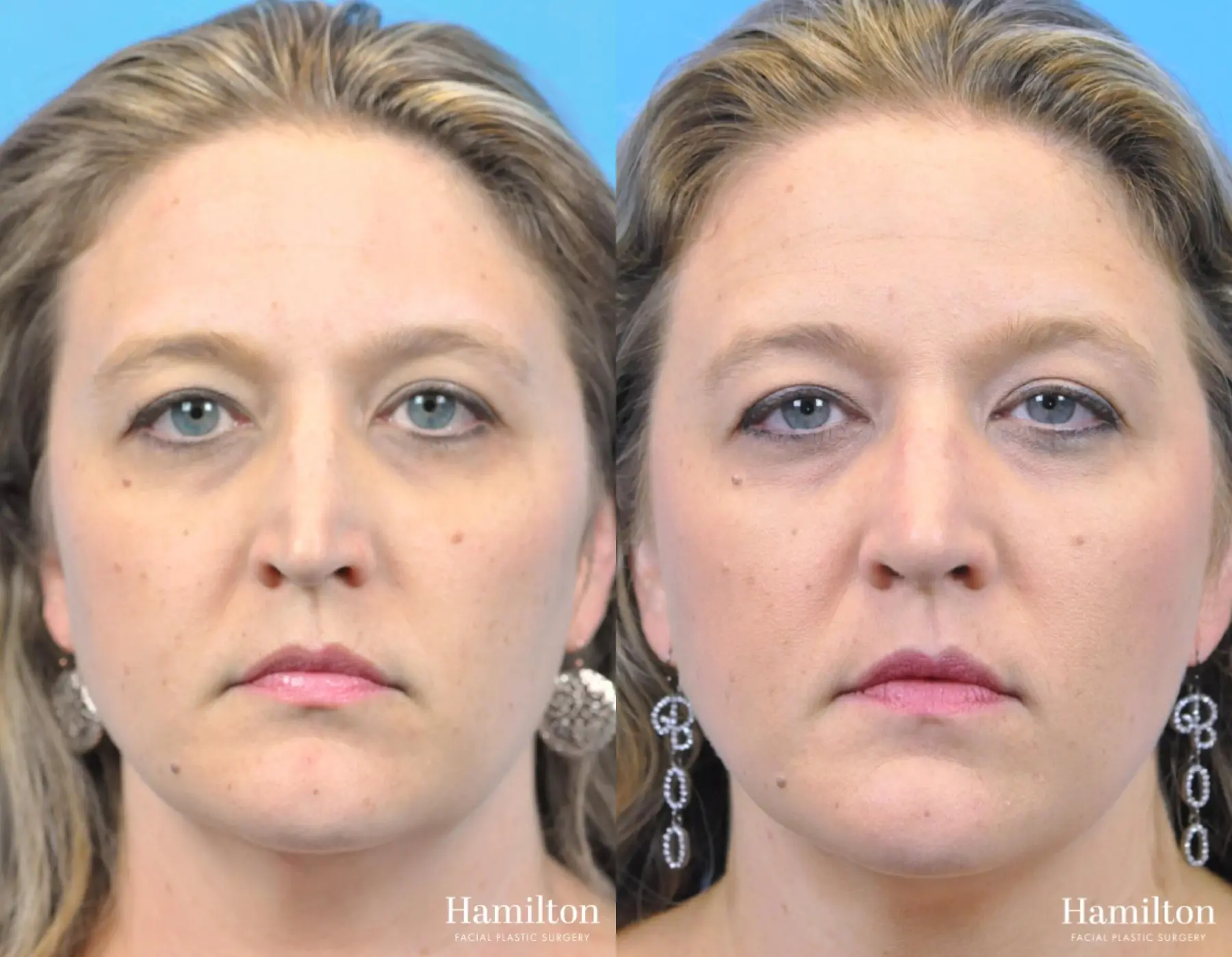 Rhinoplasty: Patient 39 - Before and After 5