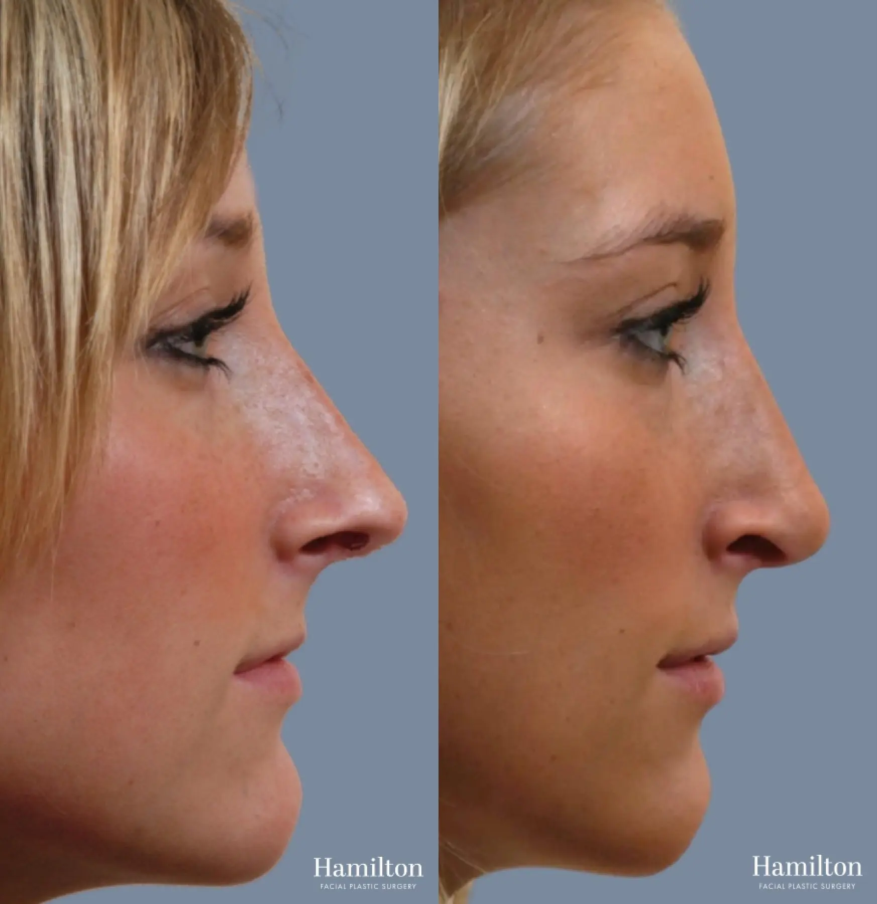 Rhinoplasty: Patient 9 - Before and After 4