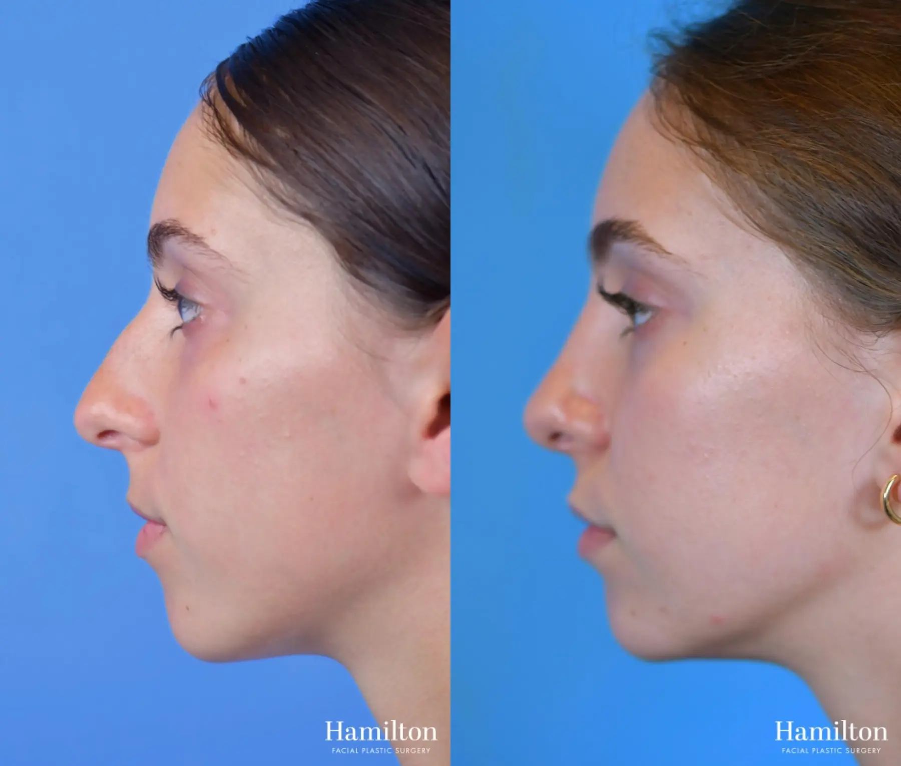 Rhinoplasty: Patient 3 - Before and After 4