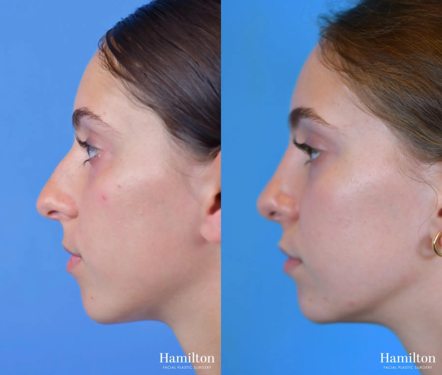 Rhinoplasty: Patient 1 - Before and After 4