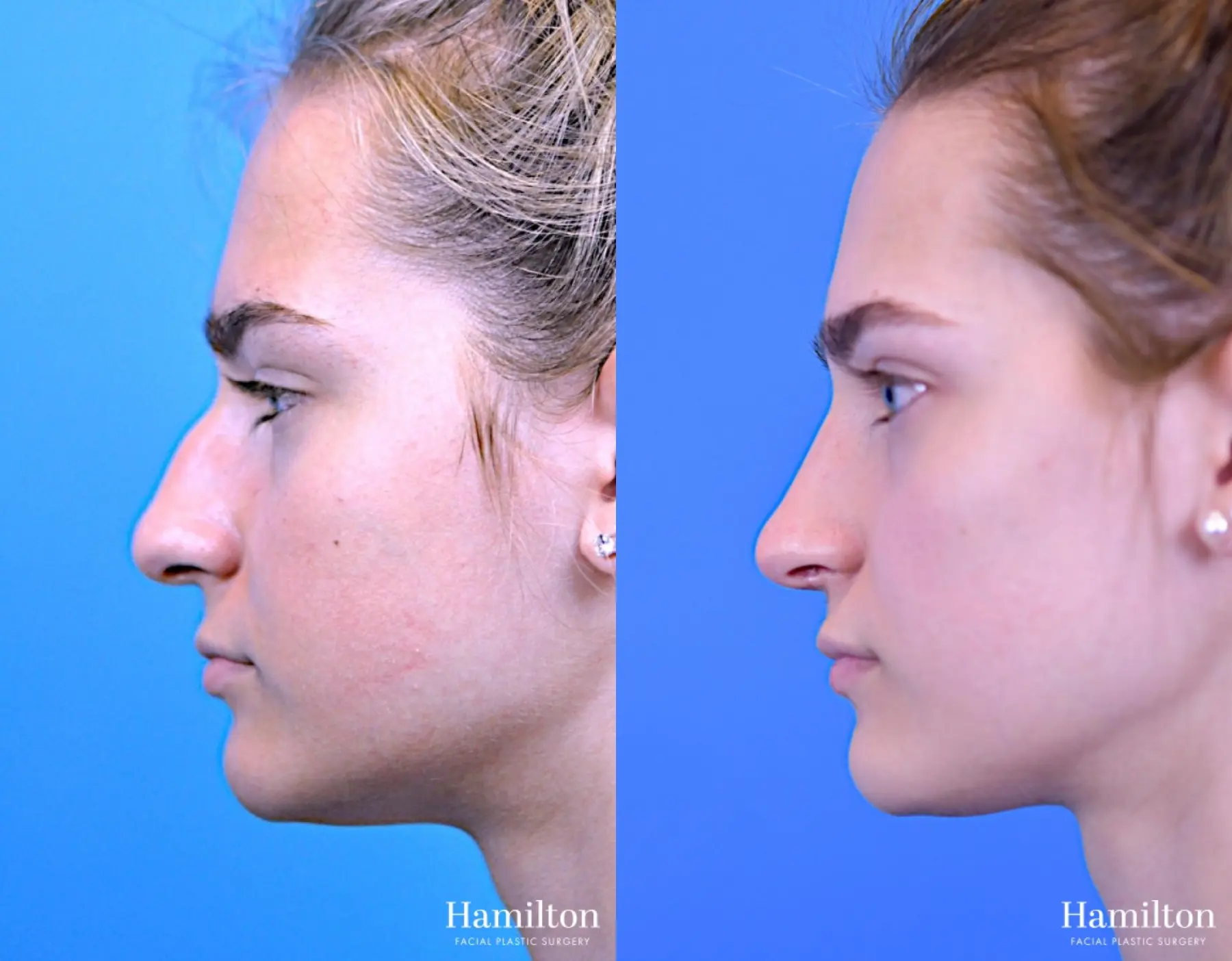 Rhinoplasty: Patient 13 - Before and After 3