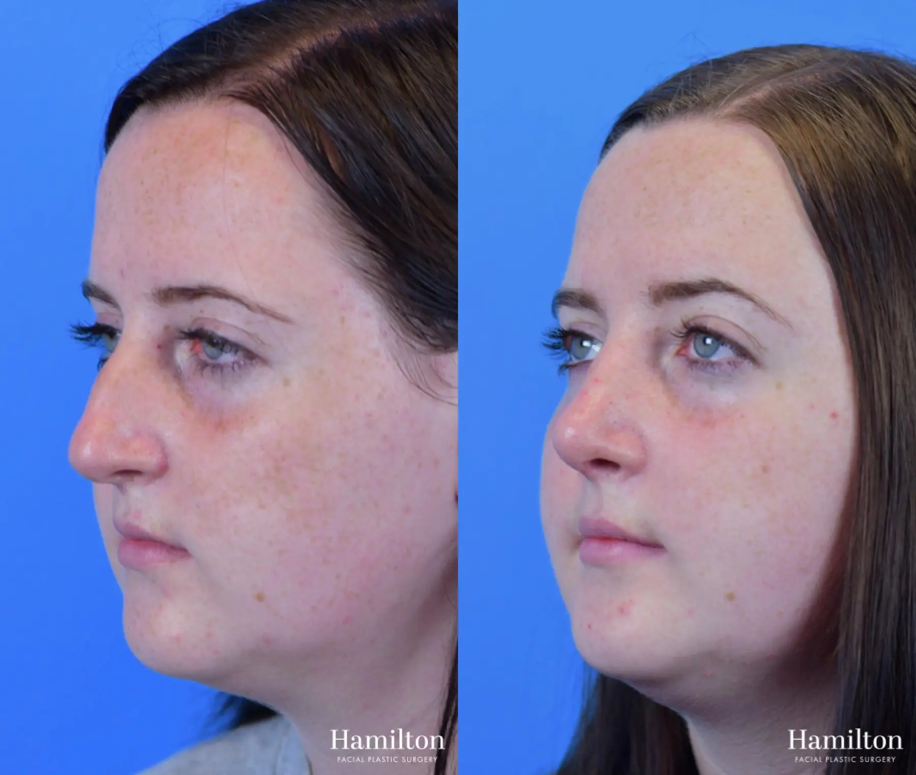 Rhinoplasty: Patient 23 - Before and After 4