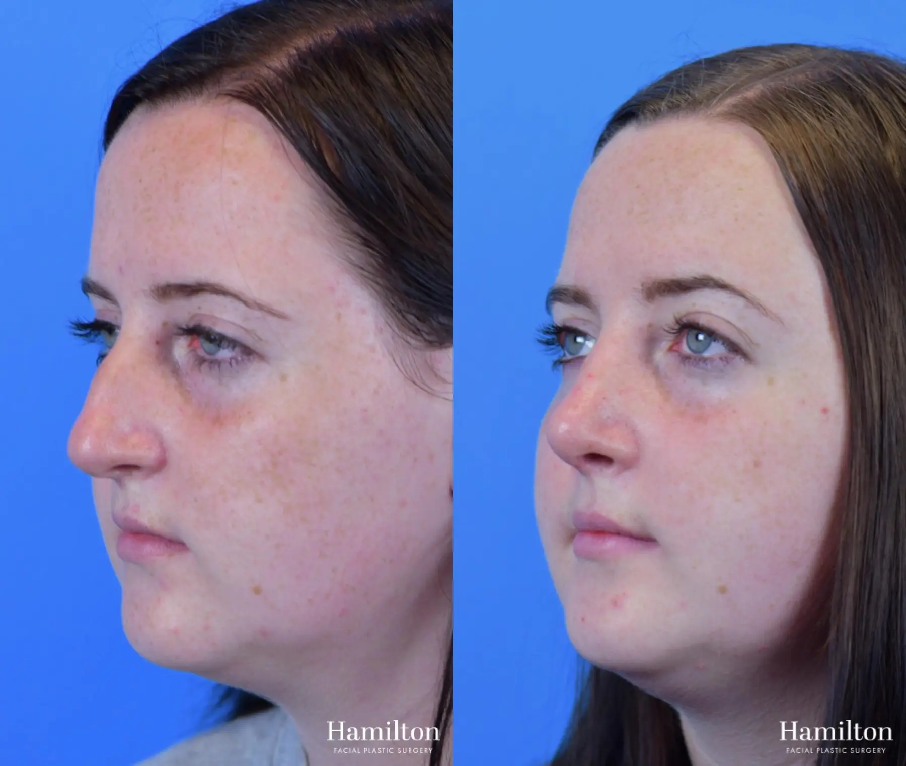Rhinoplasty: Patient 44 - Before and After 4