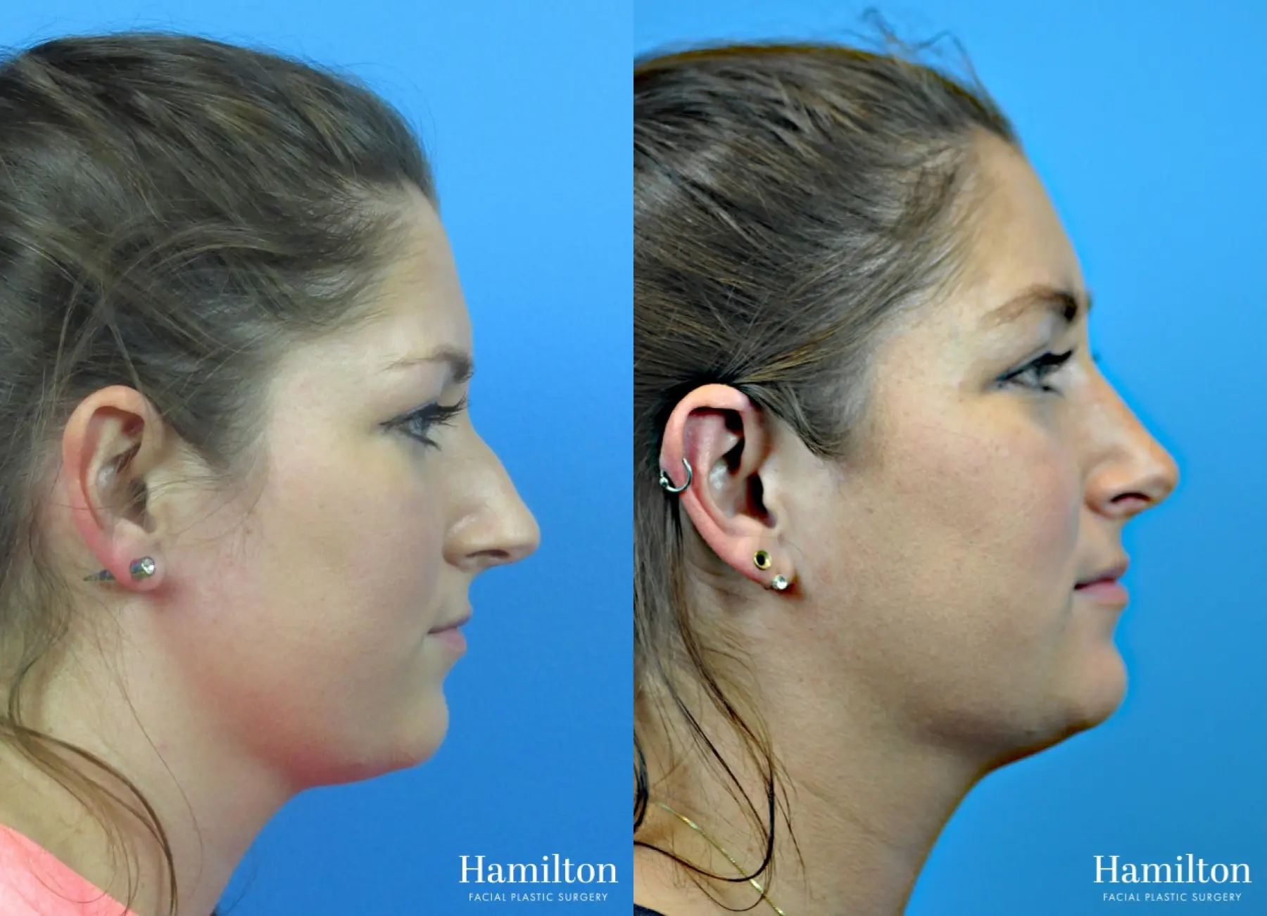 Rhinoplasty: Patient 34 - Before and After 2