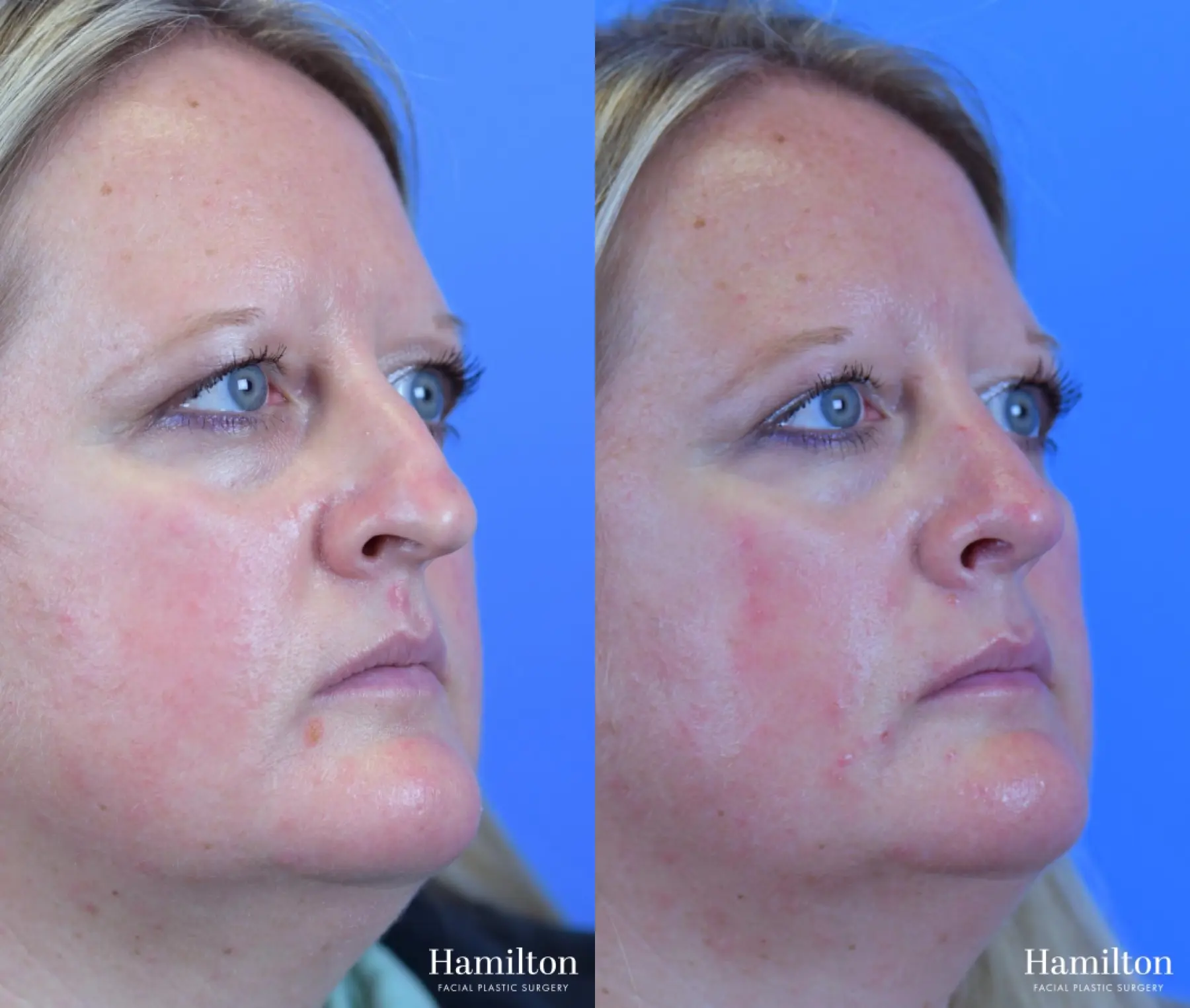 Rhinoplasty: Patient 35 - Before and After 3