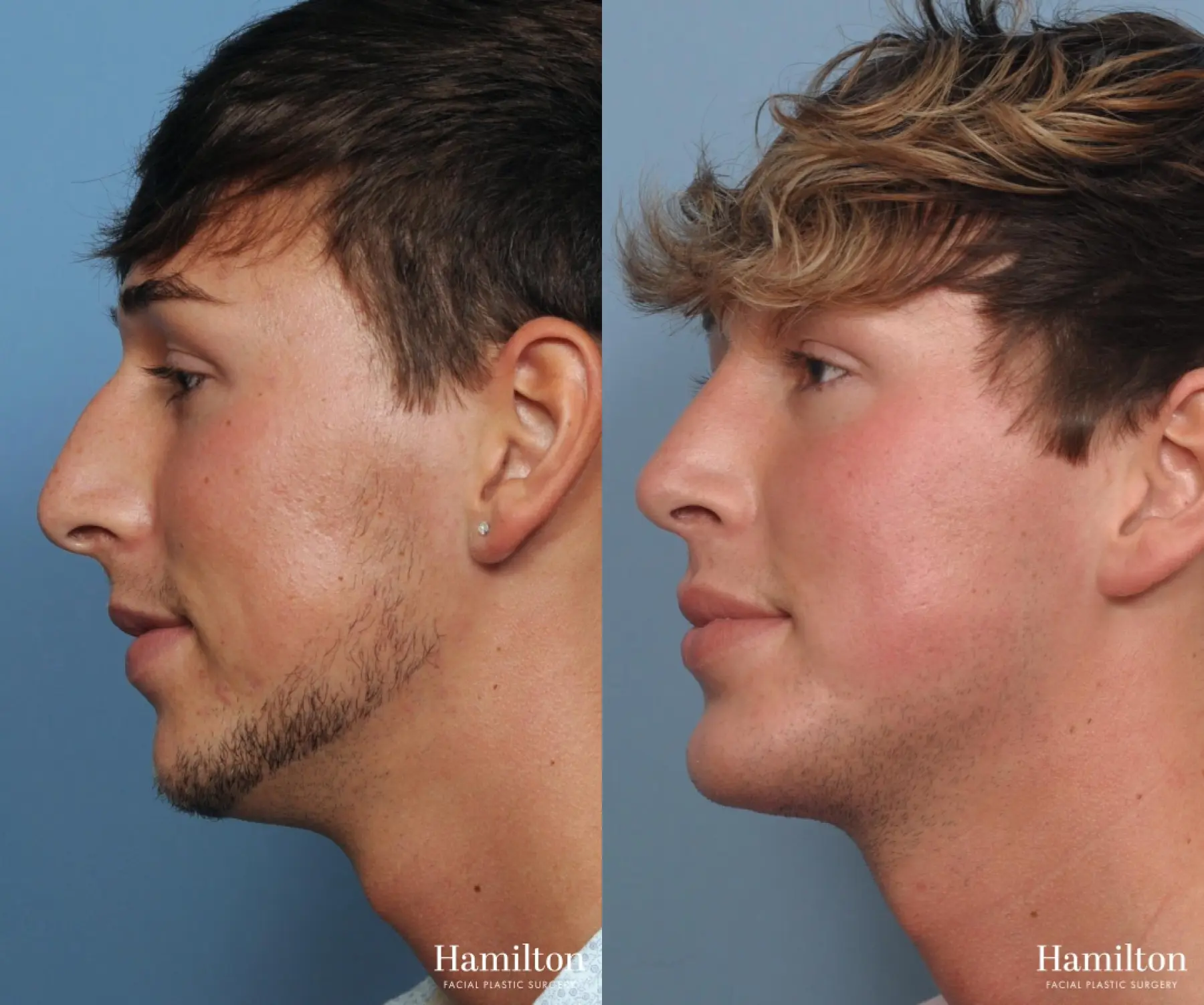 Rhinoplasty: Patient 25 - Before and After  