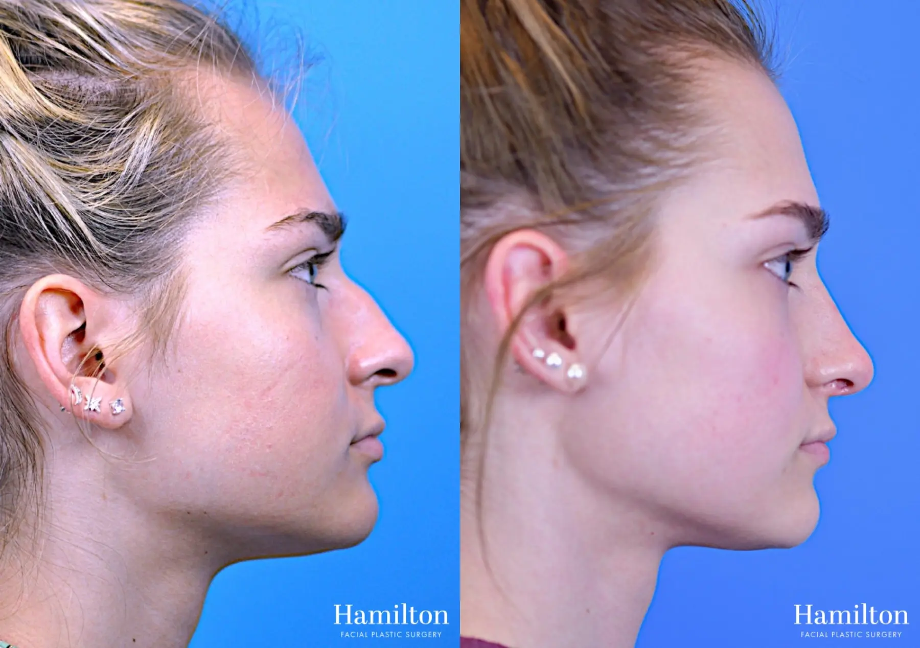 Rhinoplasty: Patient 13 - Before and After 1
