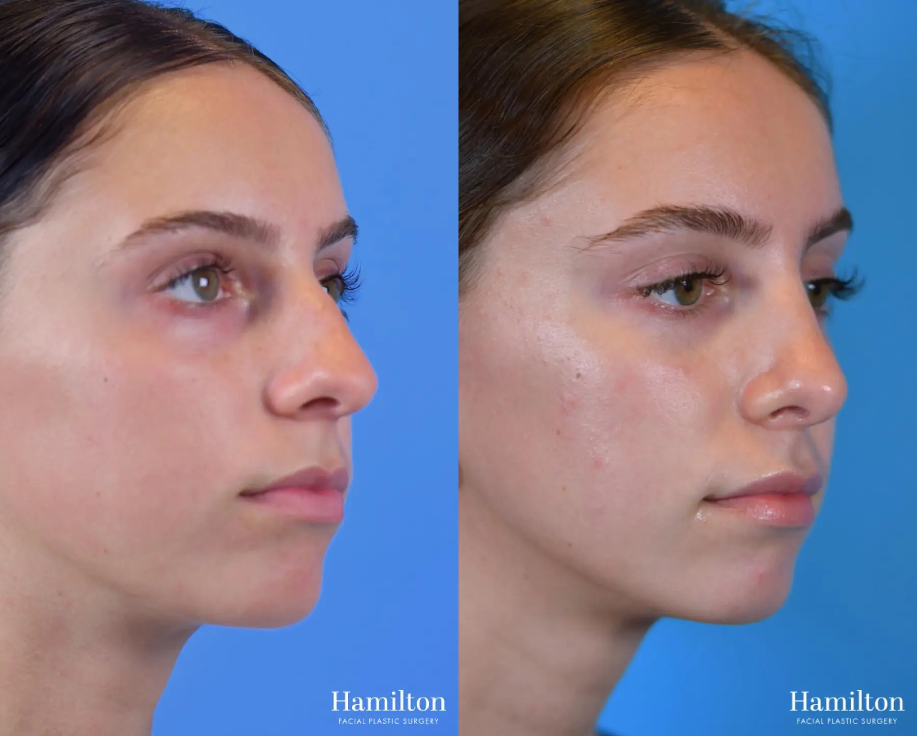 Rhinoplasty: Patient 1 - Before and After 5