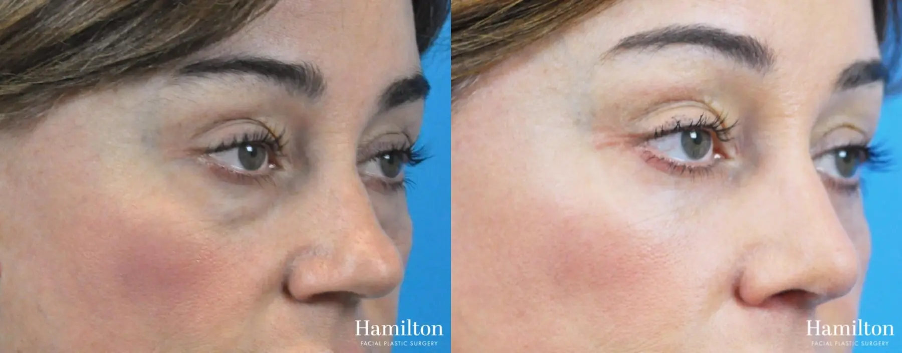 Rhinoplasty: Patient 38 - Before and After 1