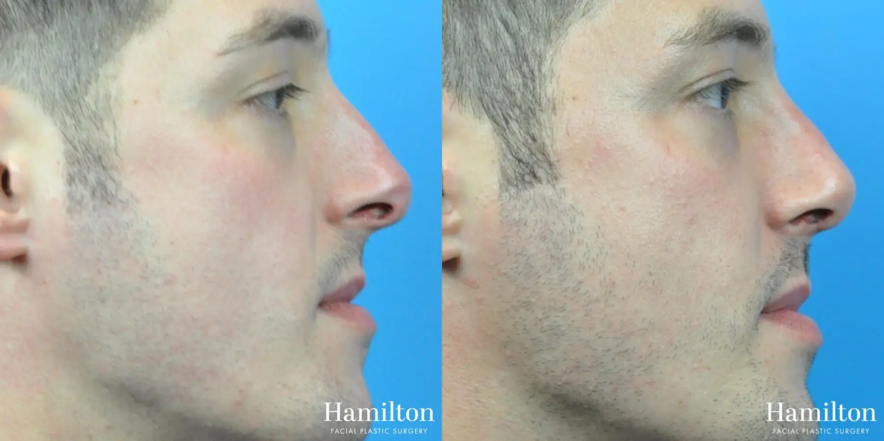 Rhinoplasty: Patient 40 - Before and After 5