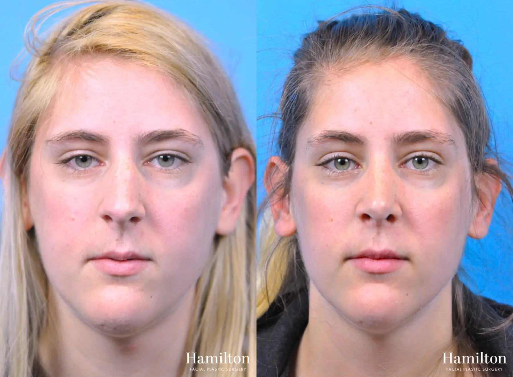 Rhinoplasty: Patient 50 - Before and After 5