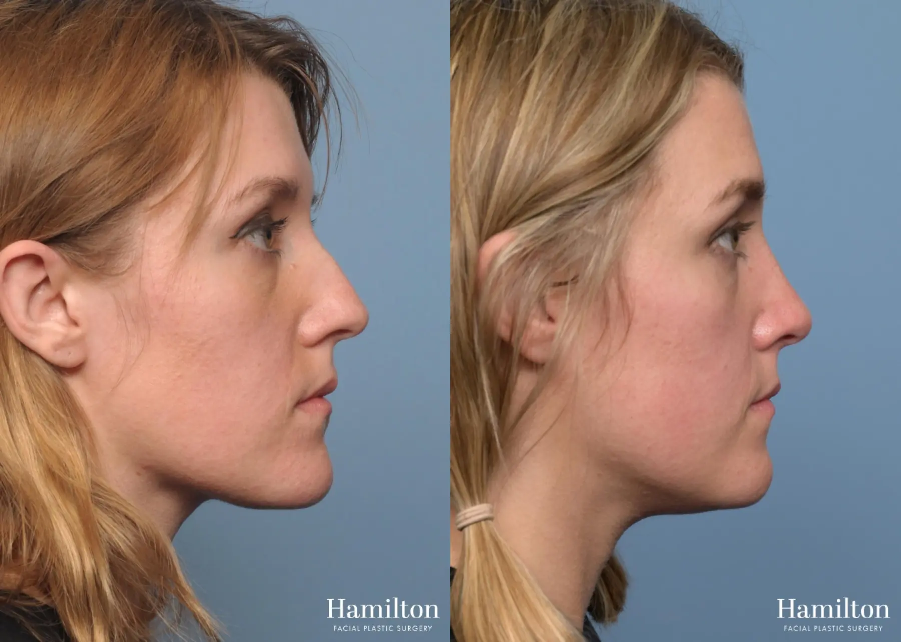 Rhinoplasty: Patient 3 - Before and After  