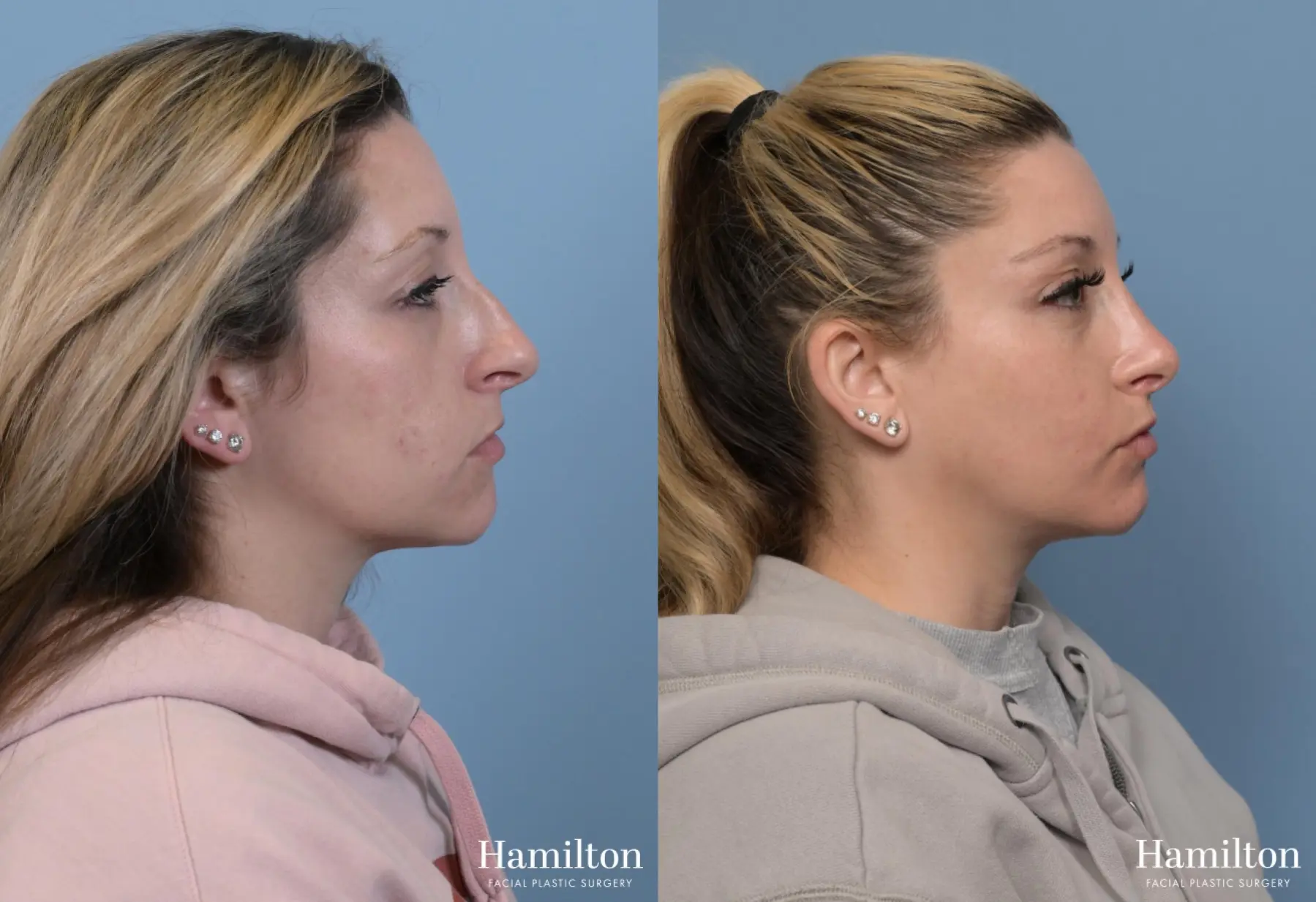 Rhinoplasty: Patient 11 - Before and After 2