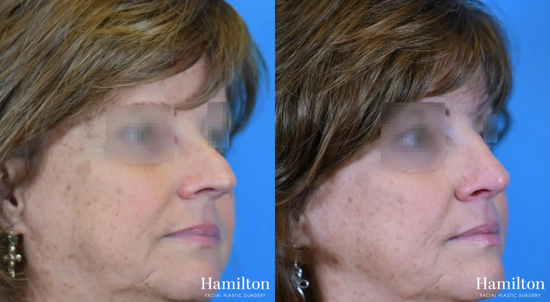 Rhinoplasty: Patient 21 - Before and After 3