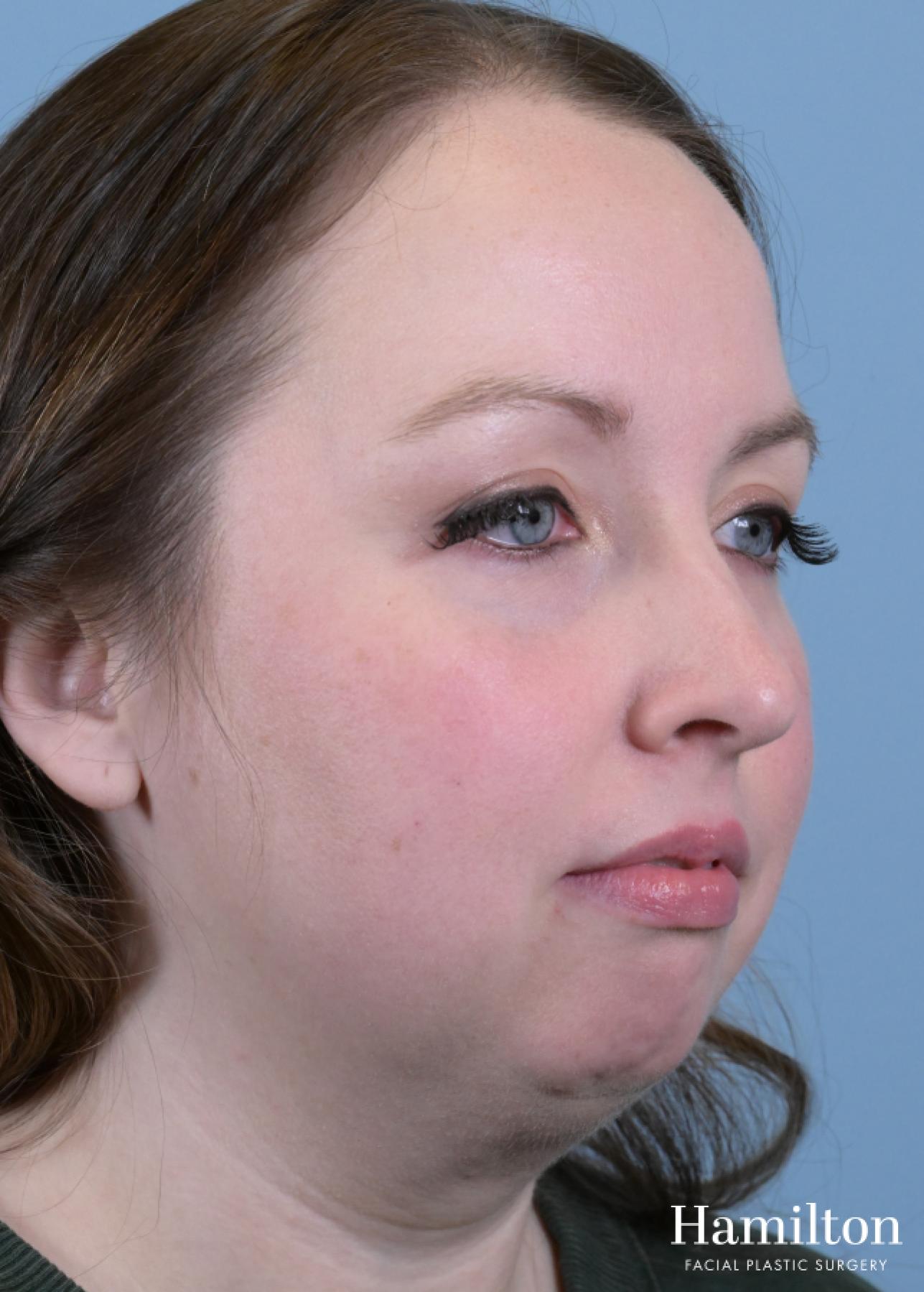 Submentoplasty/Deep Neck Lift: Patient 1 - Before and After 5