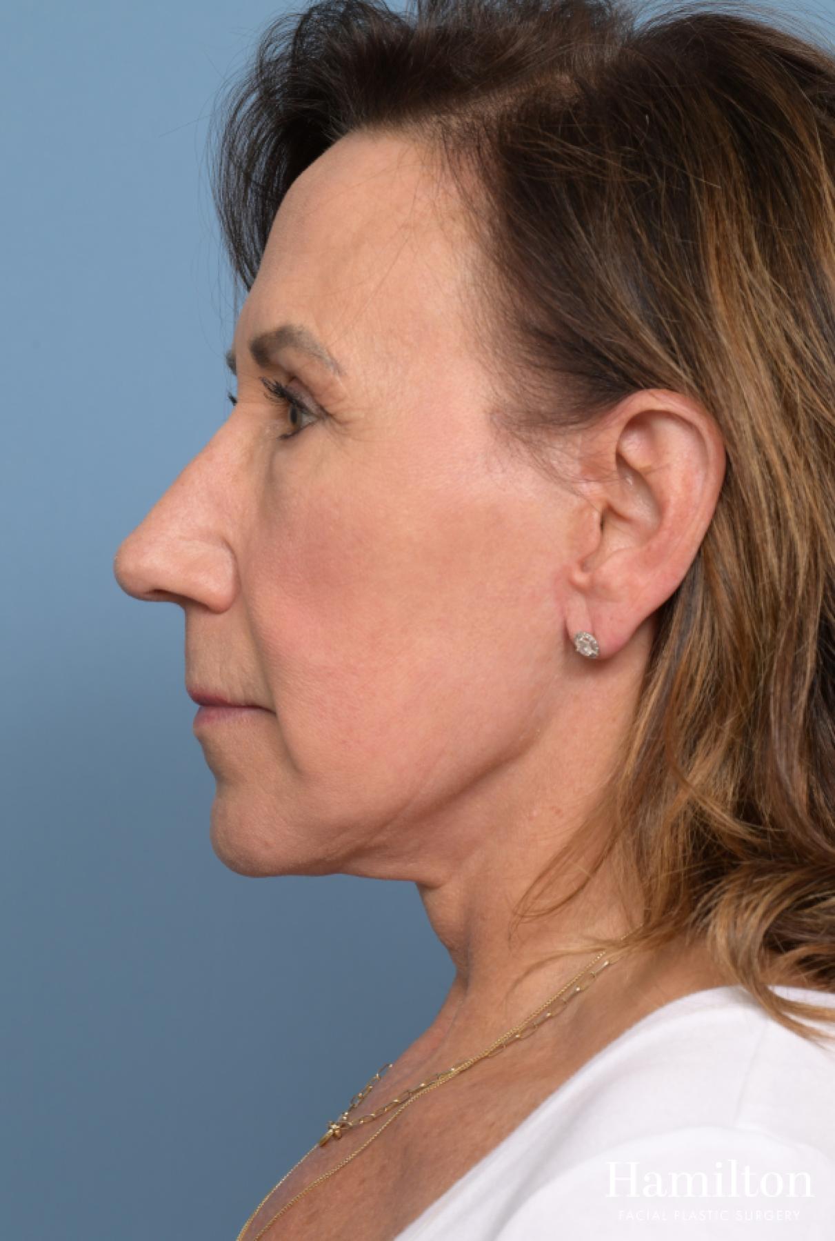 Facelift: Patient 9 - After 2