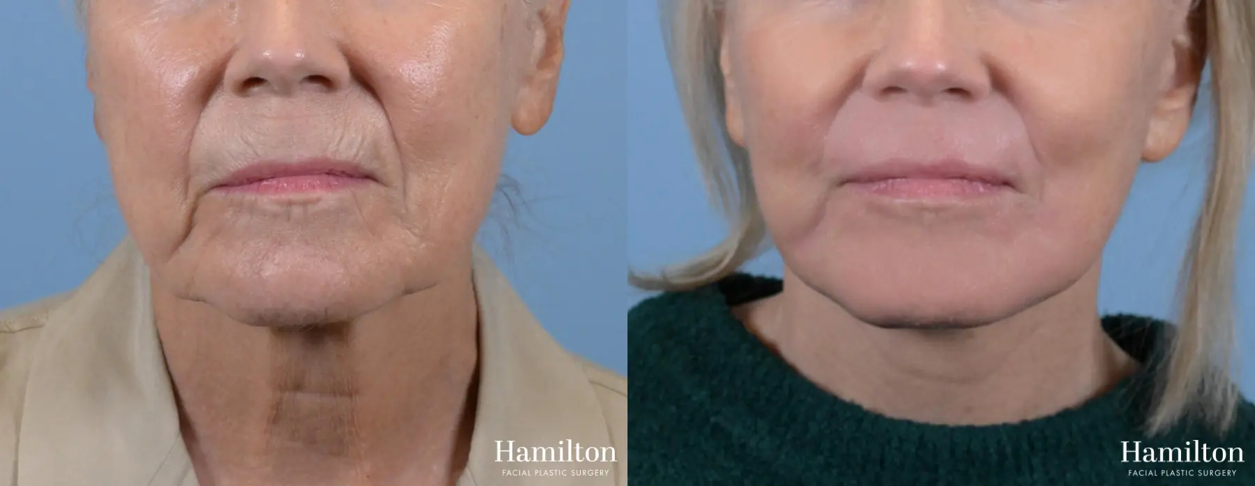 Sciton Laser: Patient 1 - Before and After  