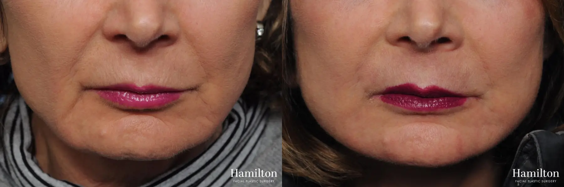 Sciton Laser: Patient 2 - Before and After 1
