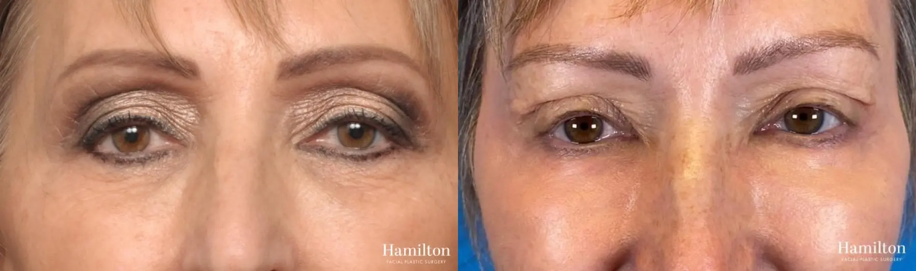 Sciton Laser: Patient 3 - Before and After 1