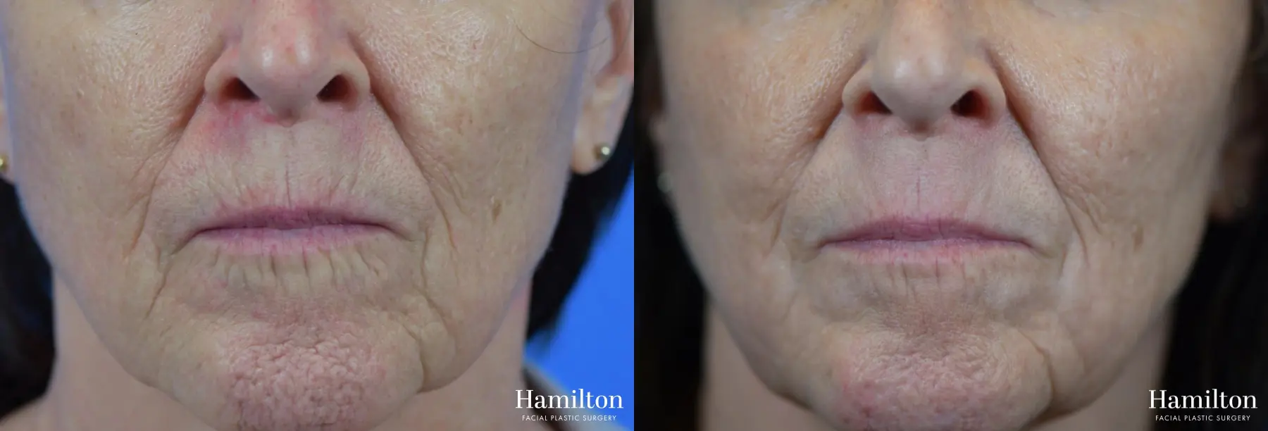 Sciton Laser: Patient 4 - Before and After 1