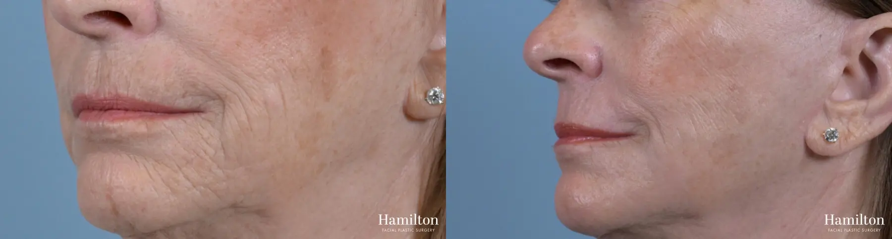 Sciton Laser: Patient 2 - Before and After 4