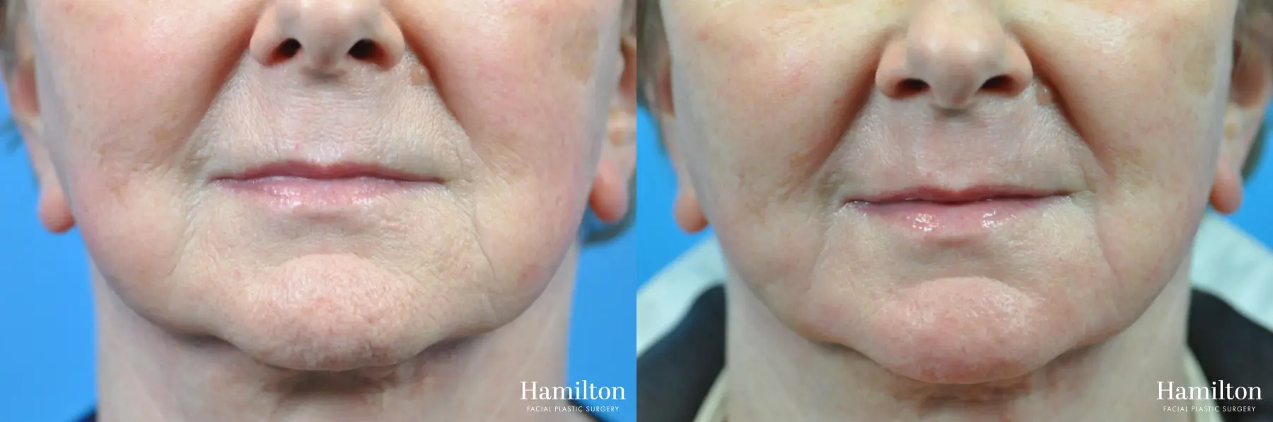 Sciton Laser: Patient 1 - Before and After  