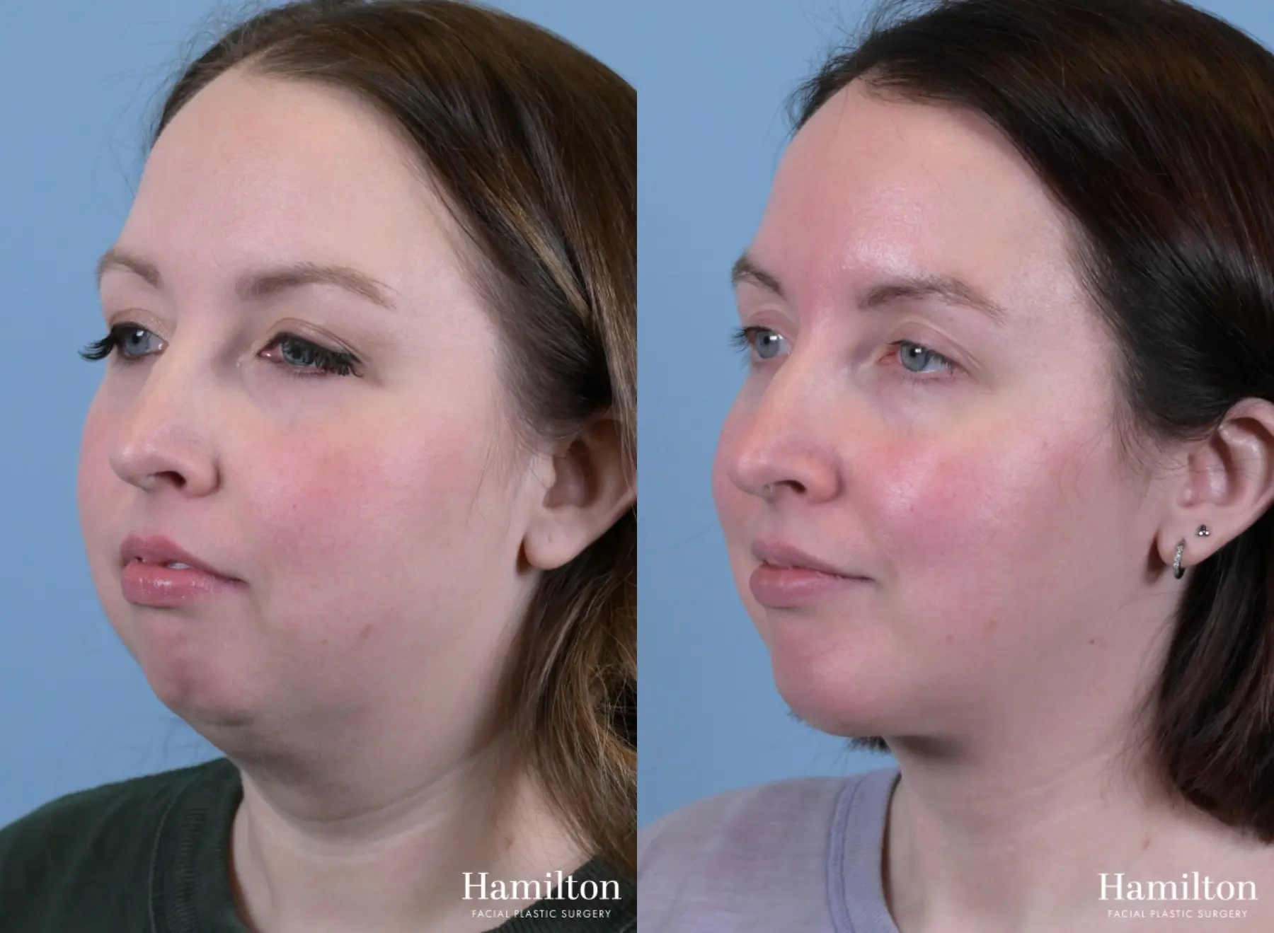 Submentoplasty/Deep Neck Lift: Patient 1 - Before and After 4