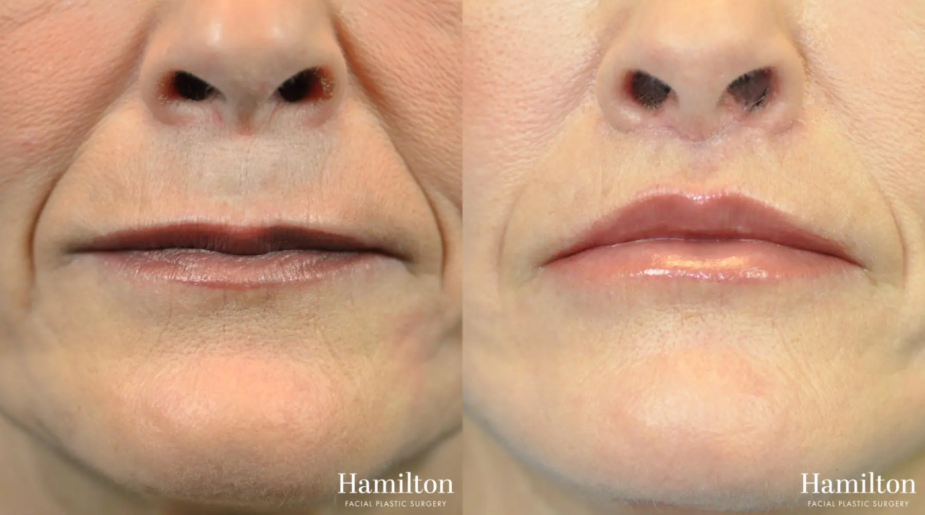 Lip Lift: Patient 2 - Before and After
