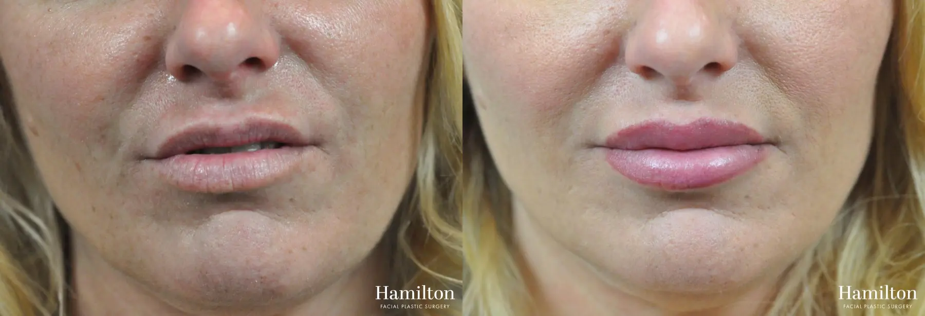 Lip Lift: Patient 3 - Before and After