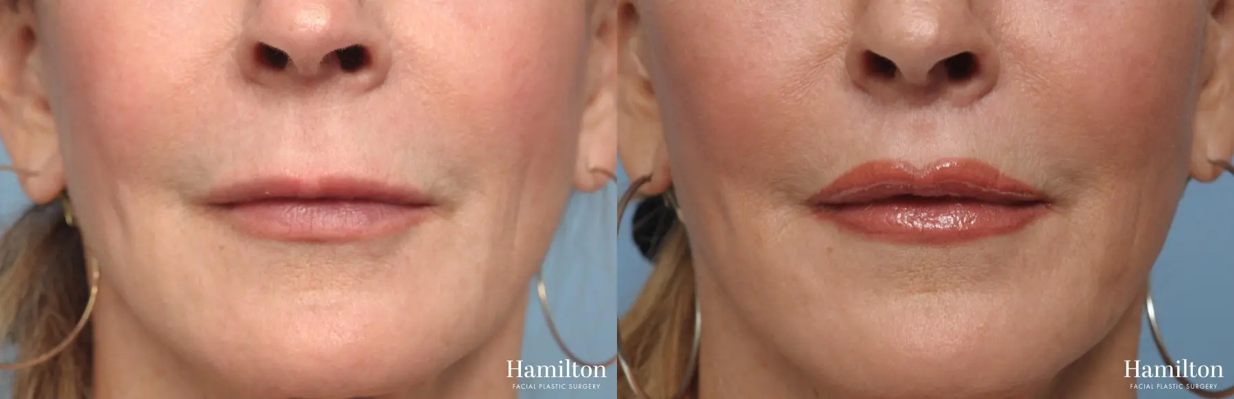 Lip Lift: Patient 1 - Before and After