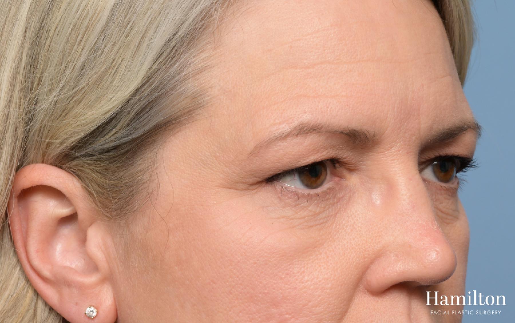 Blepharoplasty: Patient 5 - Before and After 5