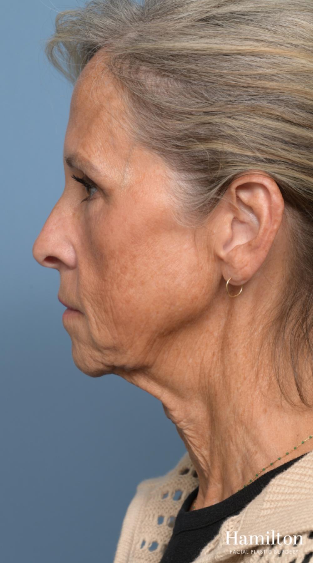 Fat Grafting: Patient 1 - Before and After 5