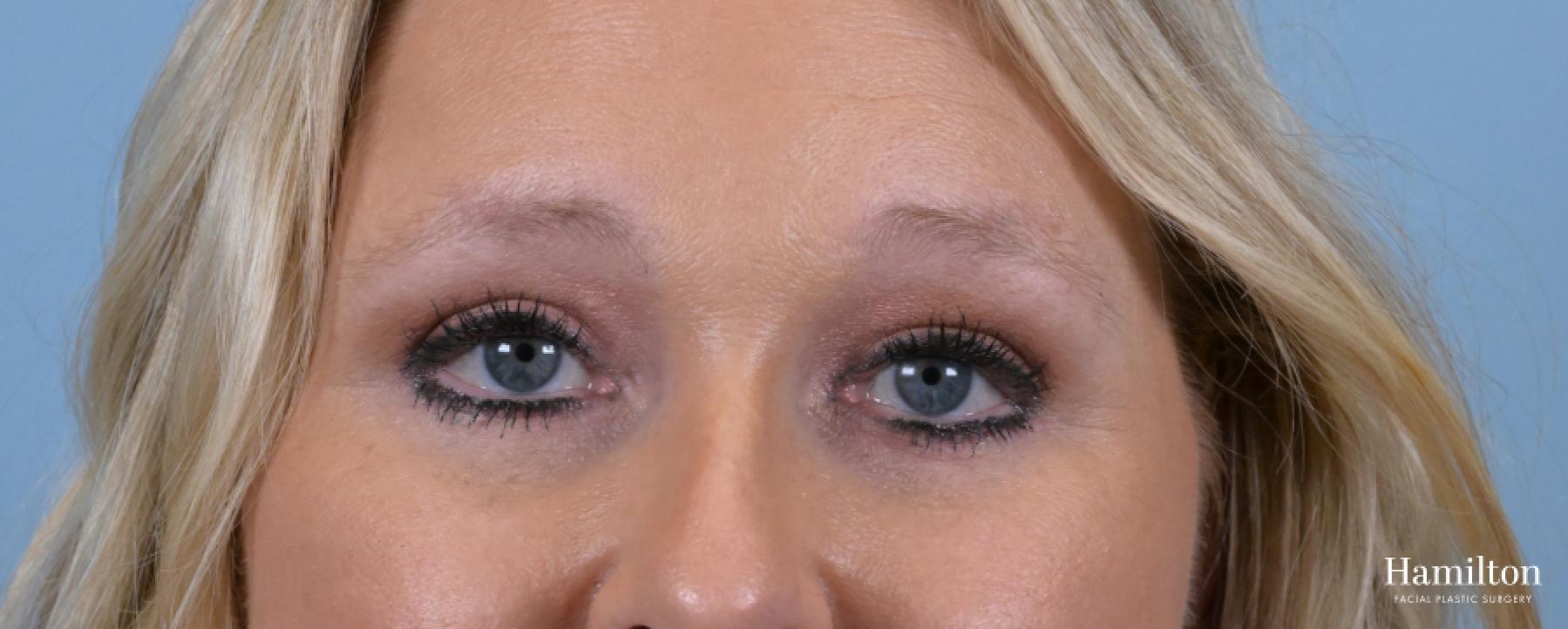Blepharoplasty: Patient 15 - After