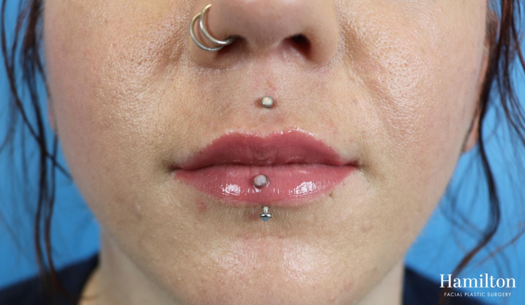 Fillers: Patient 7 - After  