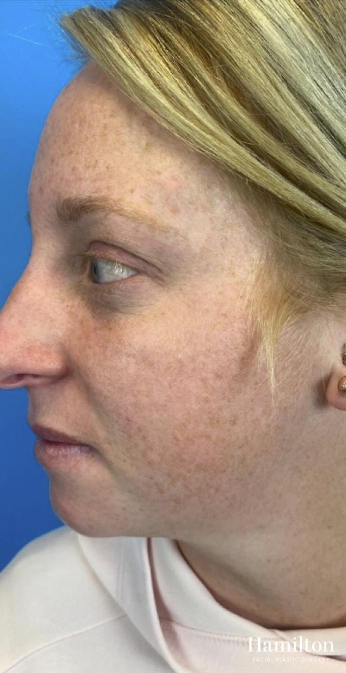 MOXI Laser: Patient 2 - Before and After 3